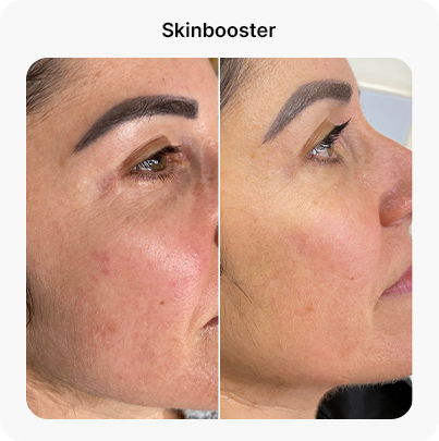 Skinbooster dra daniela leal