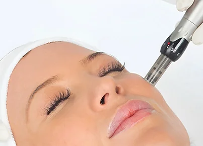 microagulhamento dra daniela leal