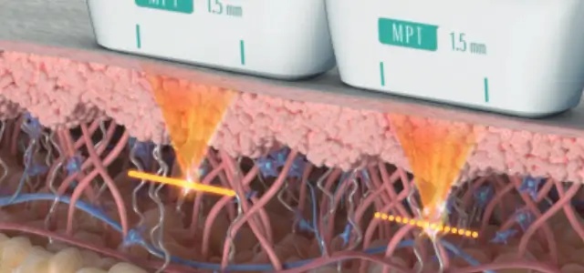passos-ultraformer-mpt-1