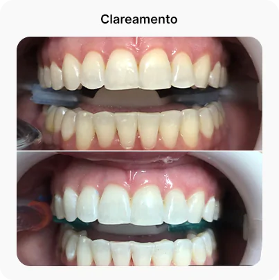 clareamento dental em florianópolis